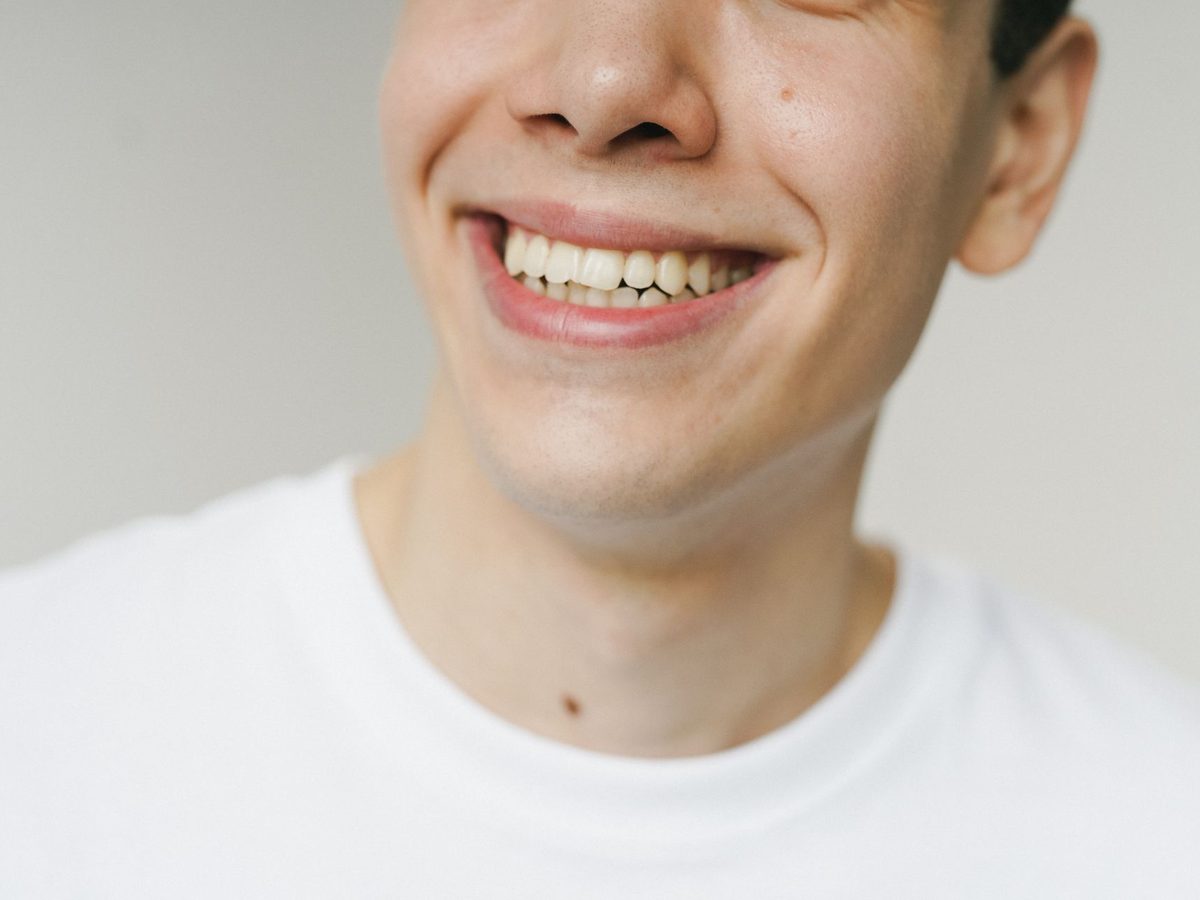 Dental bonding — smile result