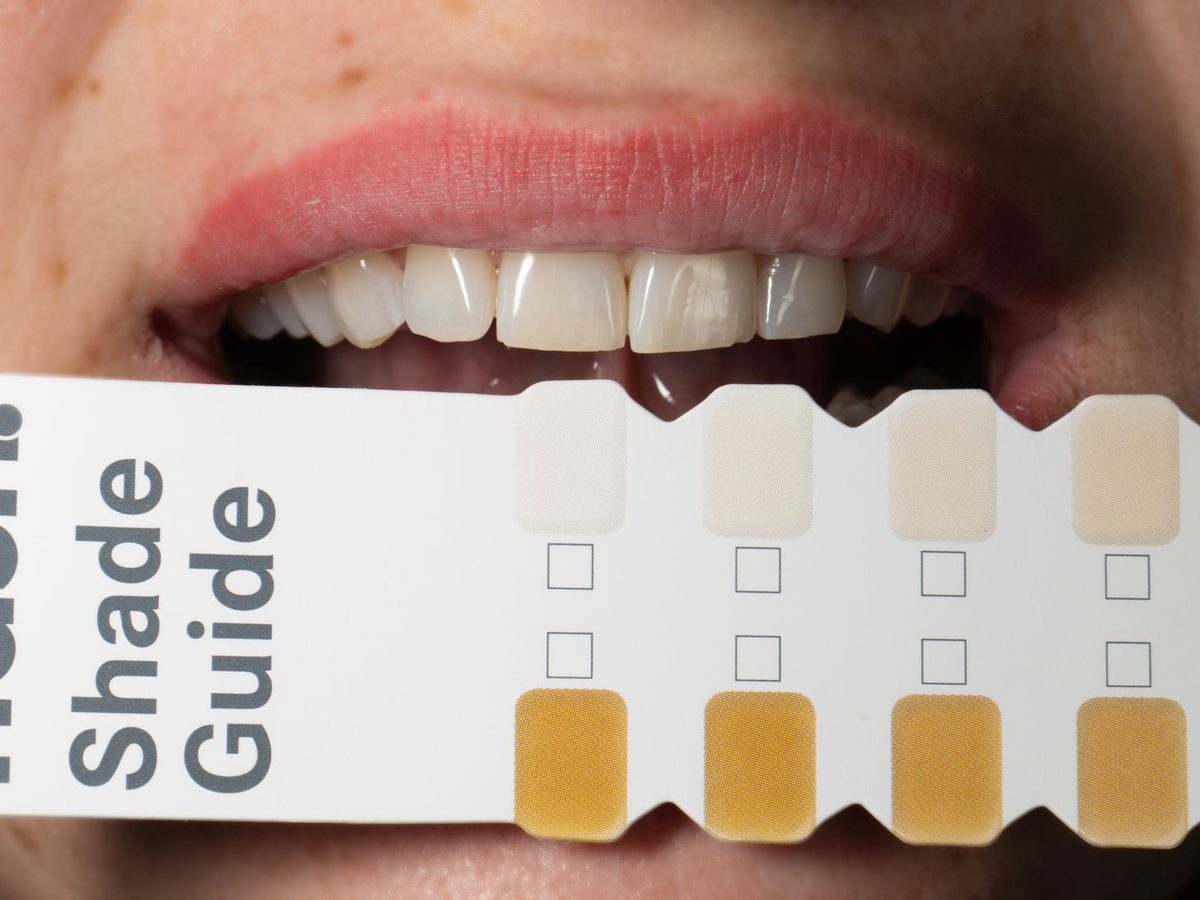 Composite fillings — smile result
