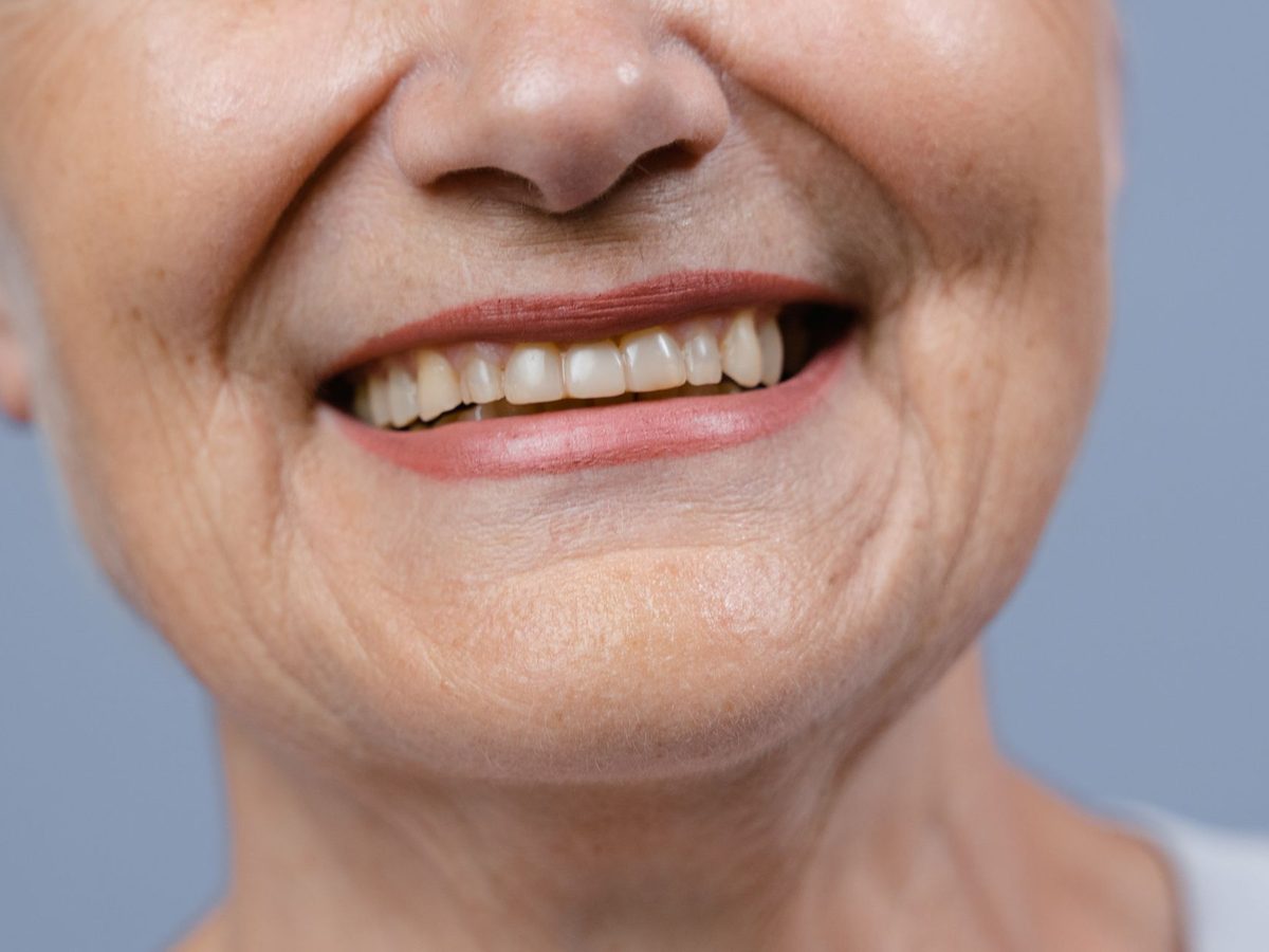 Crowns & veneers — smile result