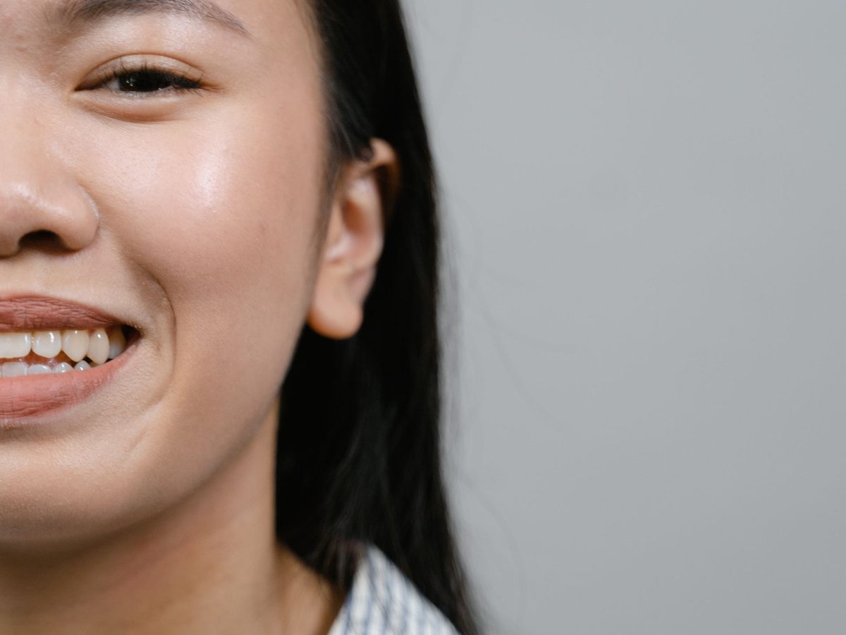 Silver-to-white fillings — smile result