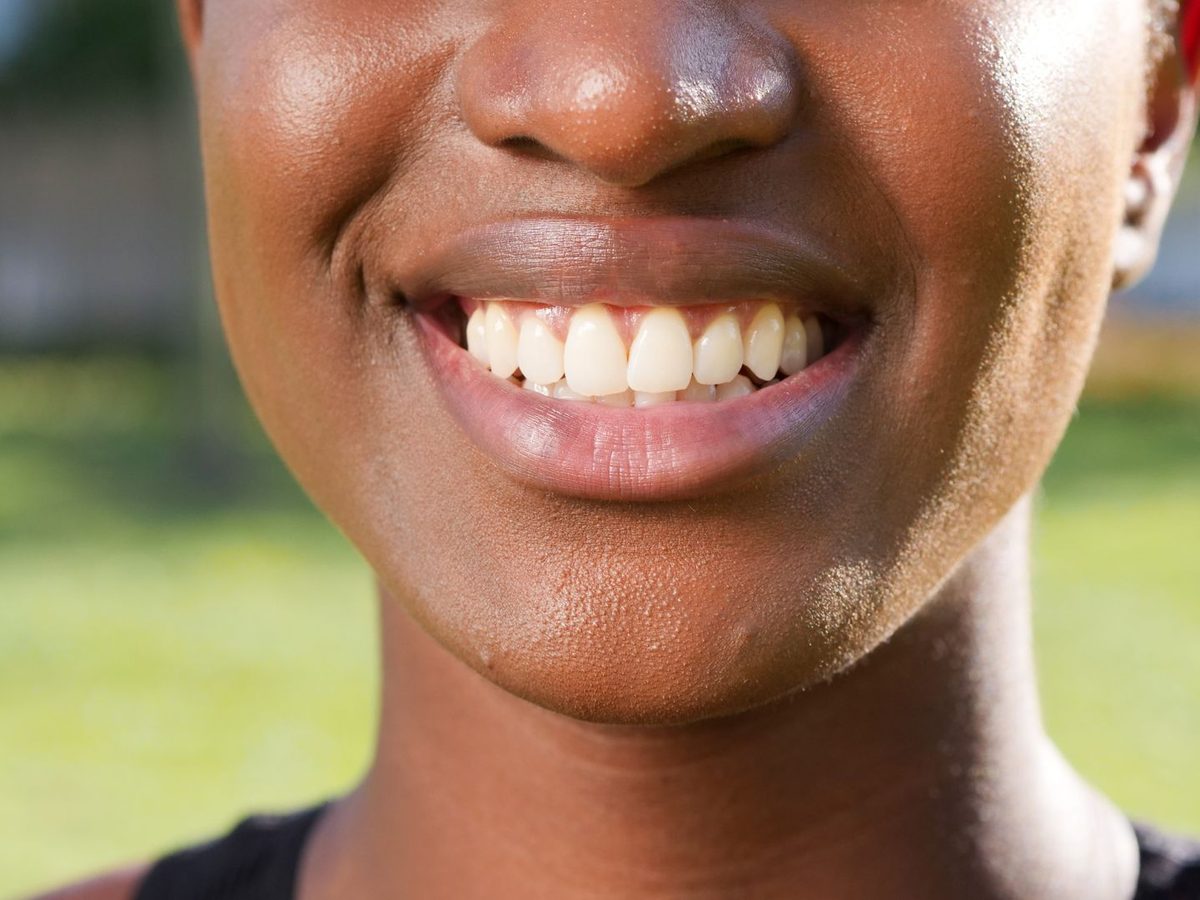 Dental implant — smile result