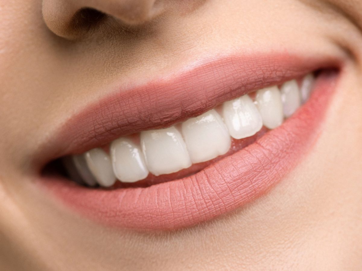Porcelain veneers — smile result