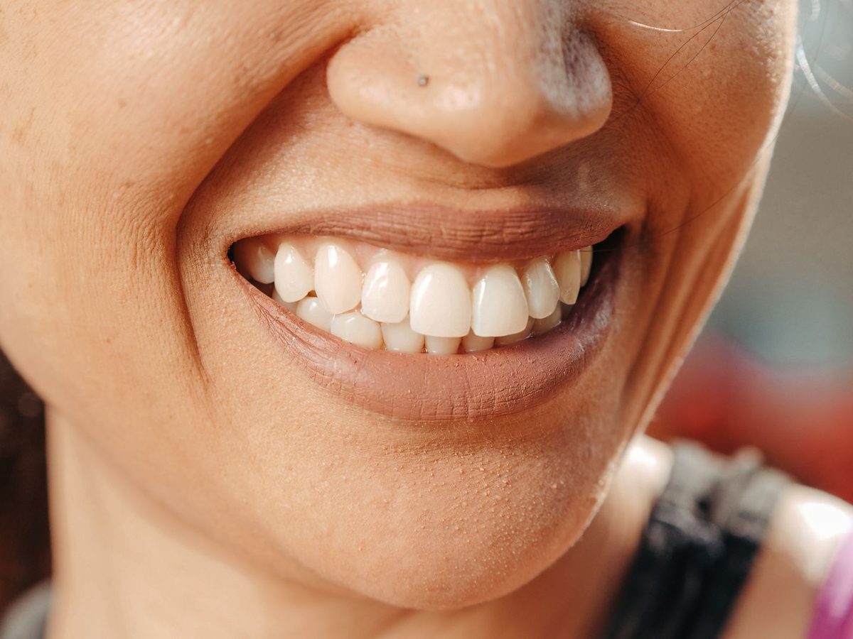 Porcelain veneers — smile result