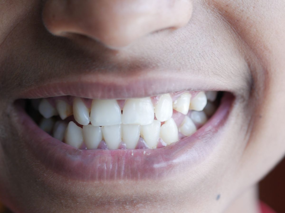 Porcelain veneers — smile result