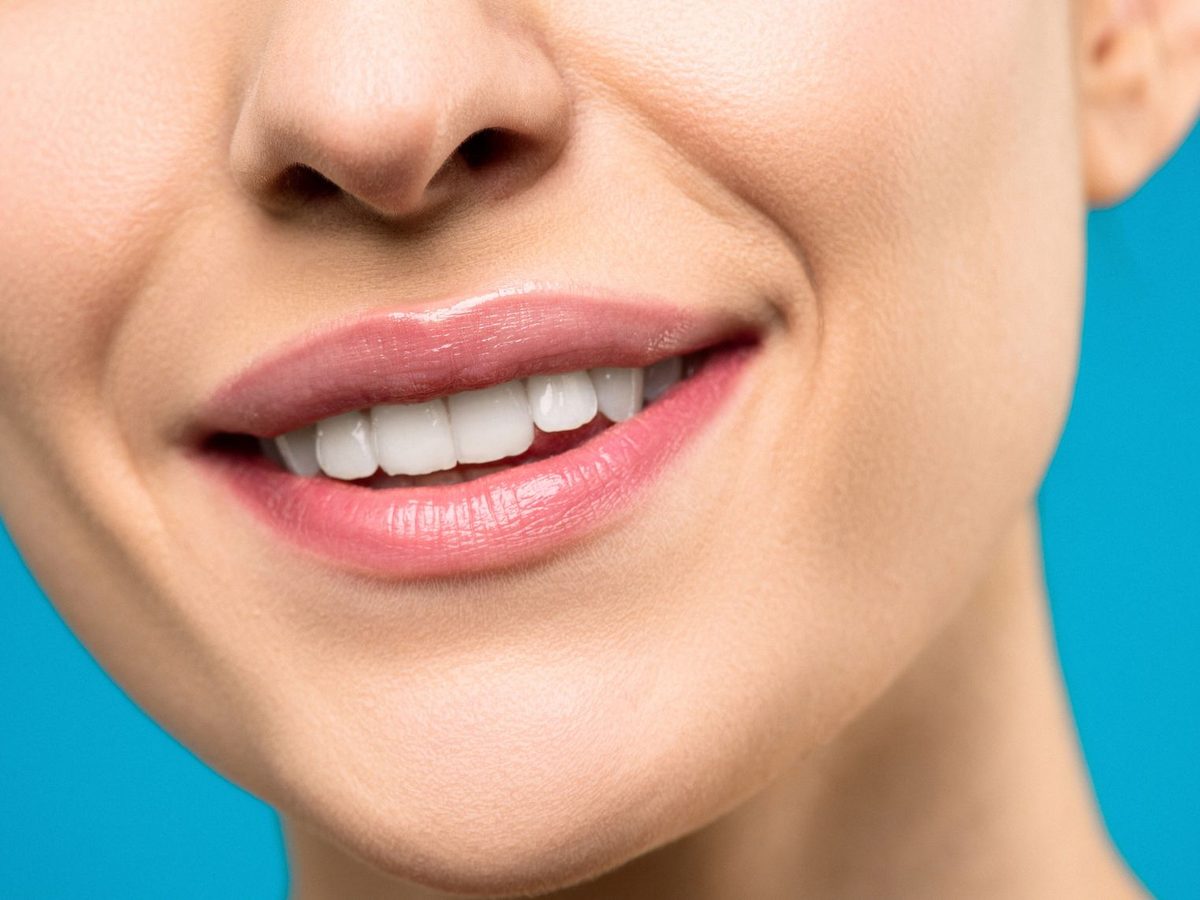 Porcelain veneers — smile result