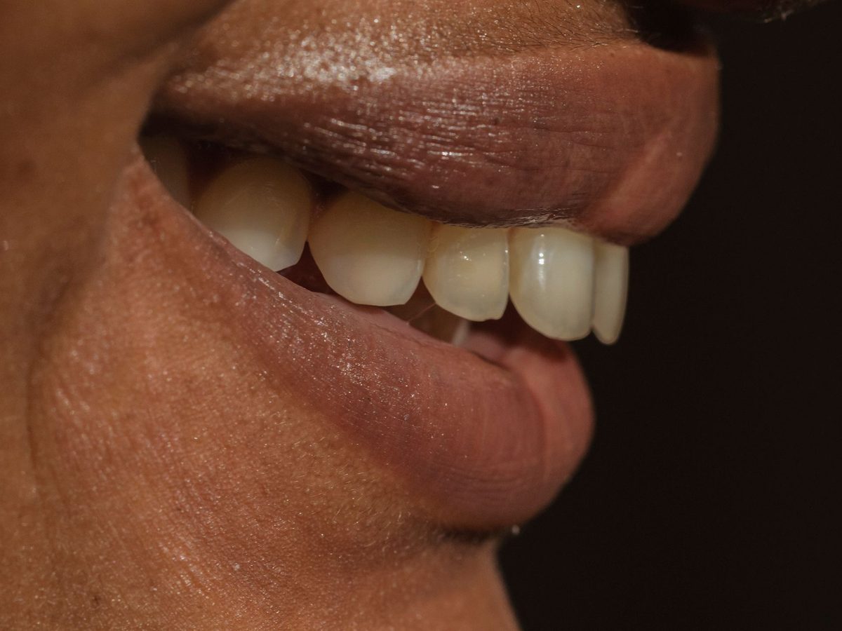 Porcelain veneers — smile result